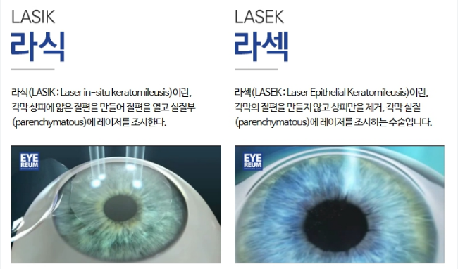 라식 vs 라섹: 시력 교정 수술의 장단점 비교