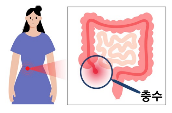 장염 증상 개선 물설사 멈추는 방법 식이요법